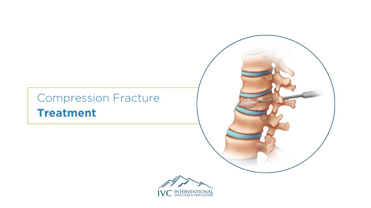 Compression Fracture Treatment