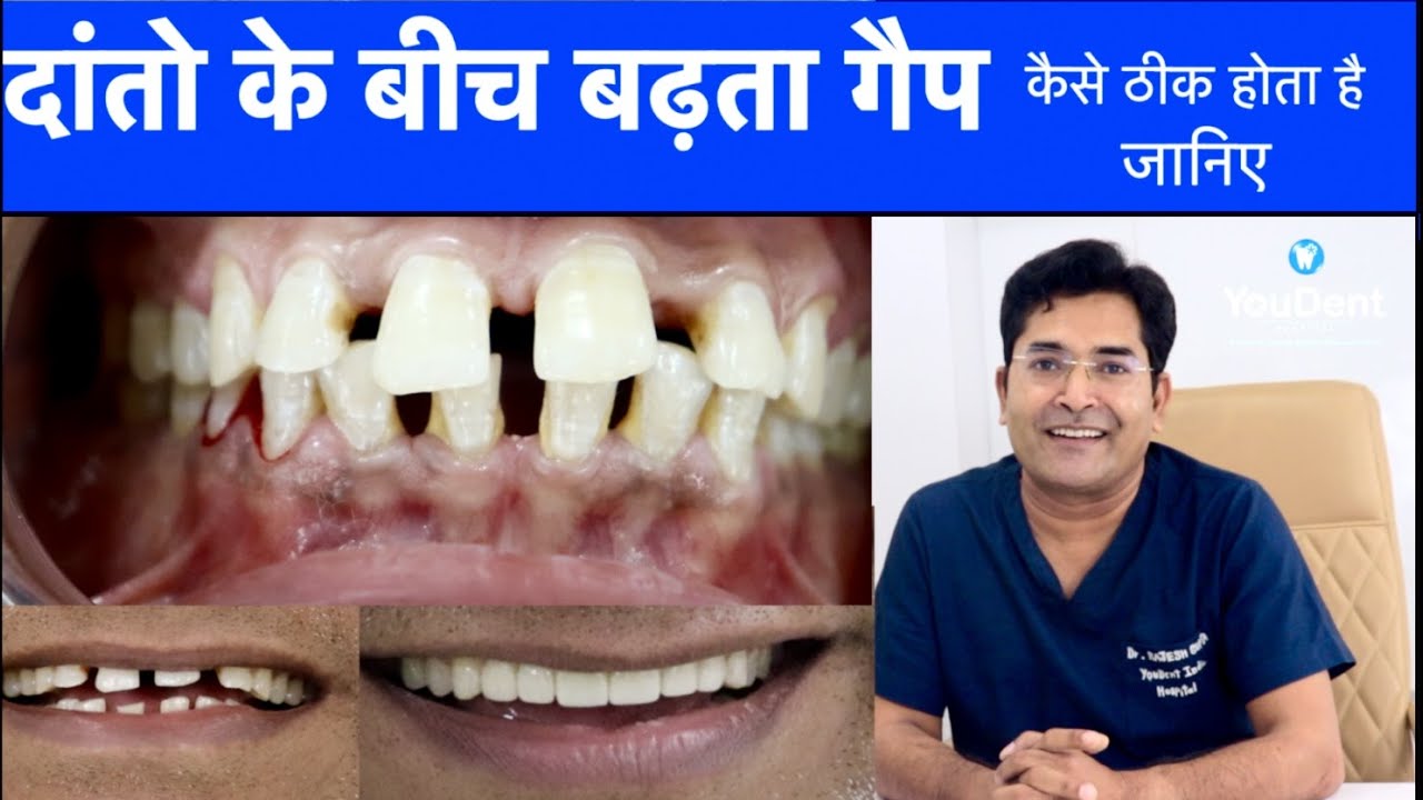 YouDent Hospital Jaipur | Best dentist in India | Best Implant Dentist in India |