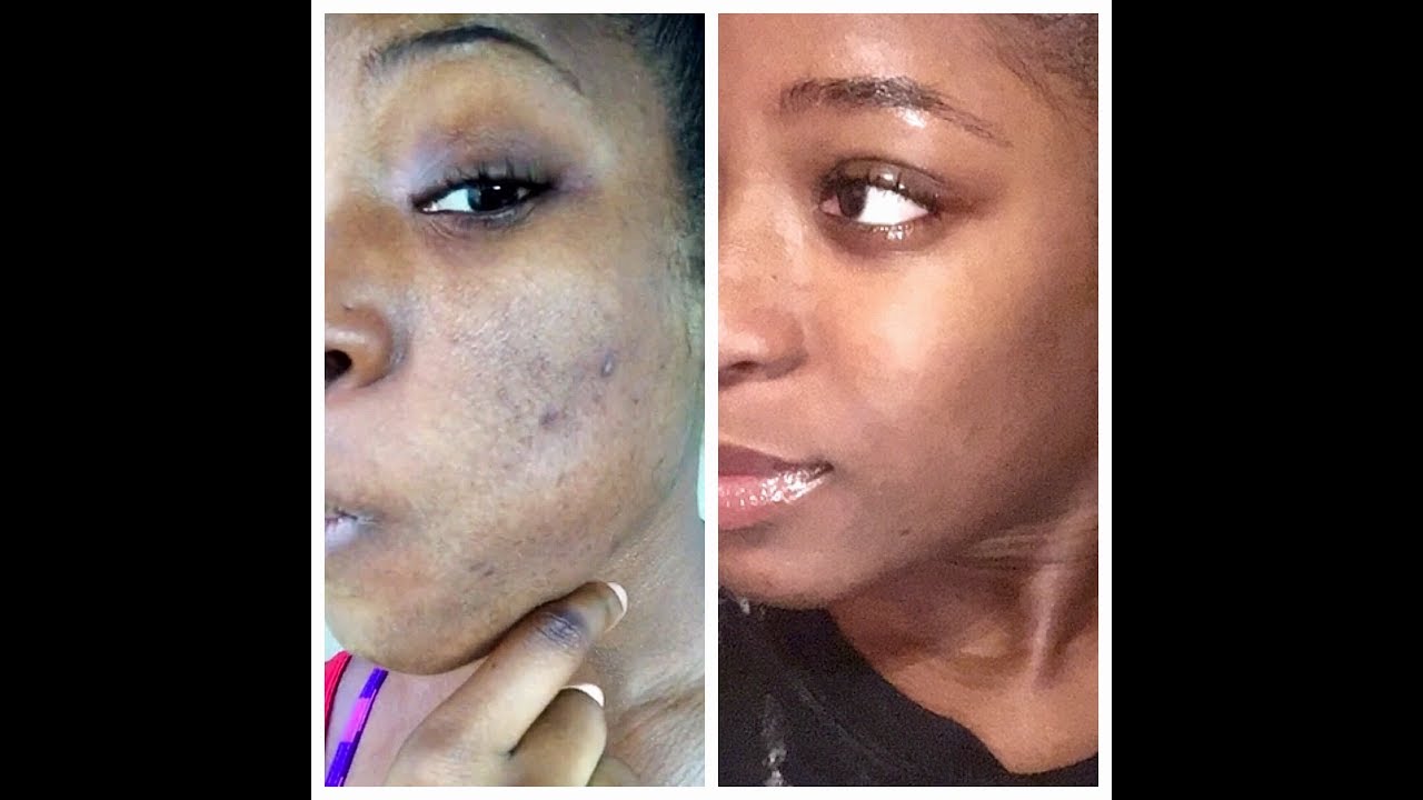 REMOVE DARK SPOTS & ACNE IN 1 WEEK (AZTEC CLAY + WASH ROUTINE)