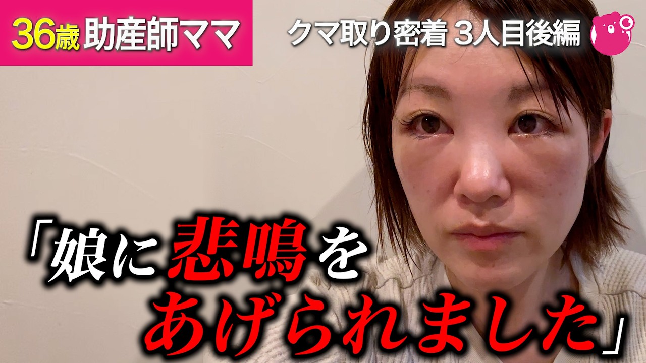【衝撃】30代ママの裏ハムラダウンタイムが想像以上…1ヶ月のリアルダウンタイムレポ【目の下のクマ取り/美容/整形】