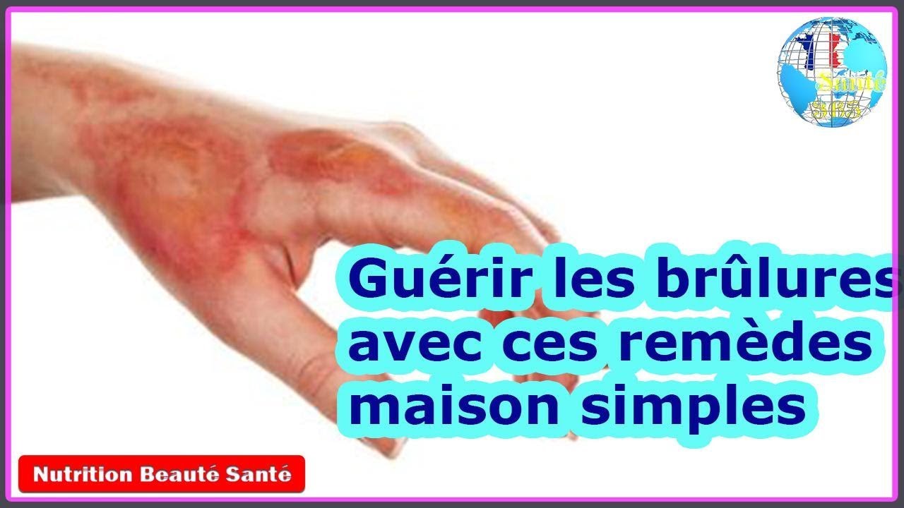 Gu&eacute;rir les br&ucirc;lures avec ces rem&egrave;des maison simples|Nutrition Beaut&eacute; Sant&eacute;