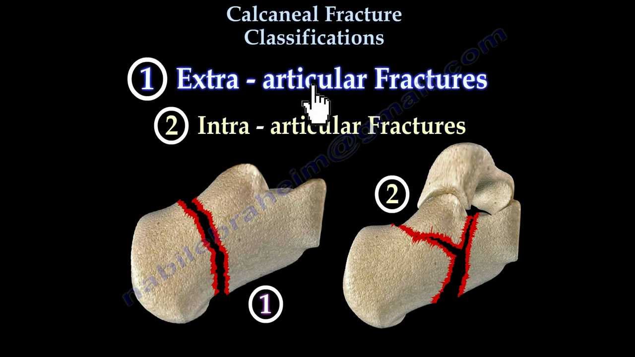 Calcaneal Fracture Classifications - Everything You Need To Know - Dr. Nabil Ebraheim