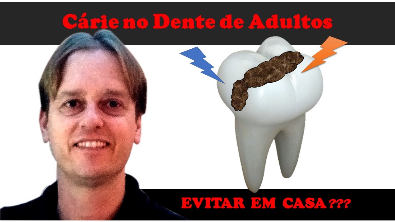 Cárie no Dente de Adultos - [#Parte 2]:  Técnica Ninja Para Evitar em Casa !