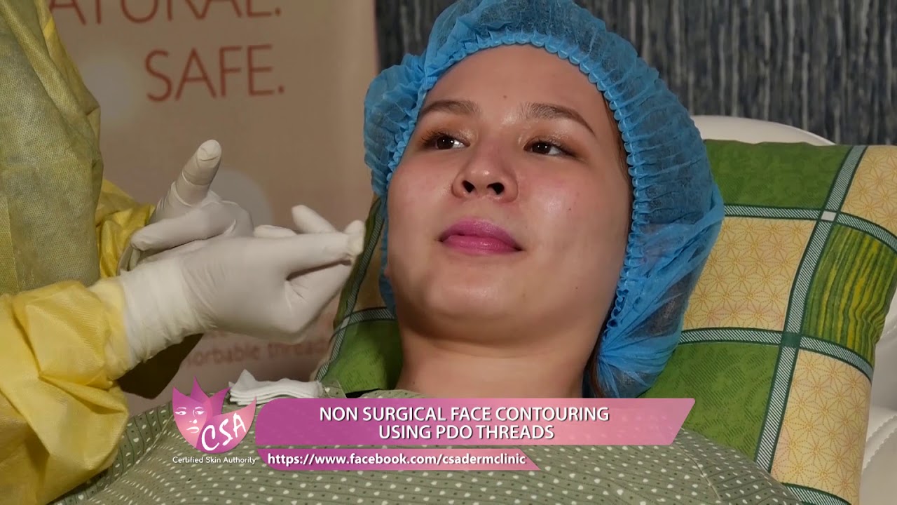 FAST NON SURGICAL FACE CONTOURING USING PDO THREADS