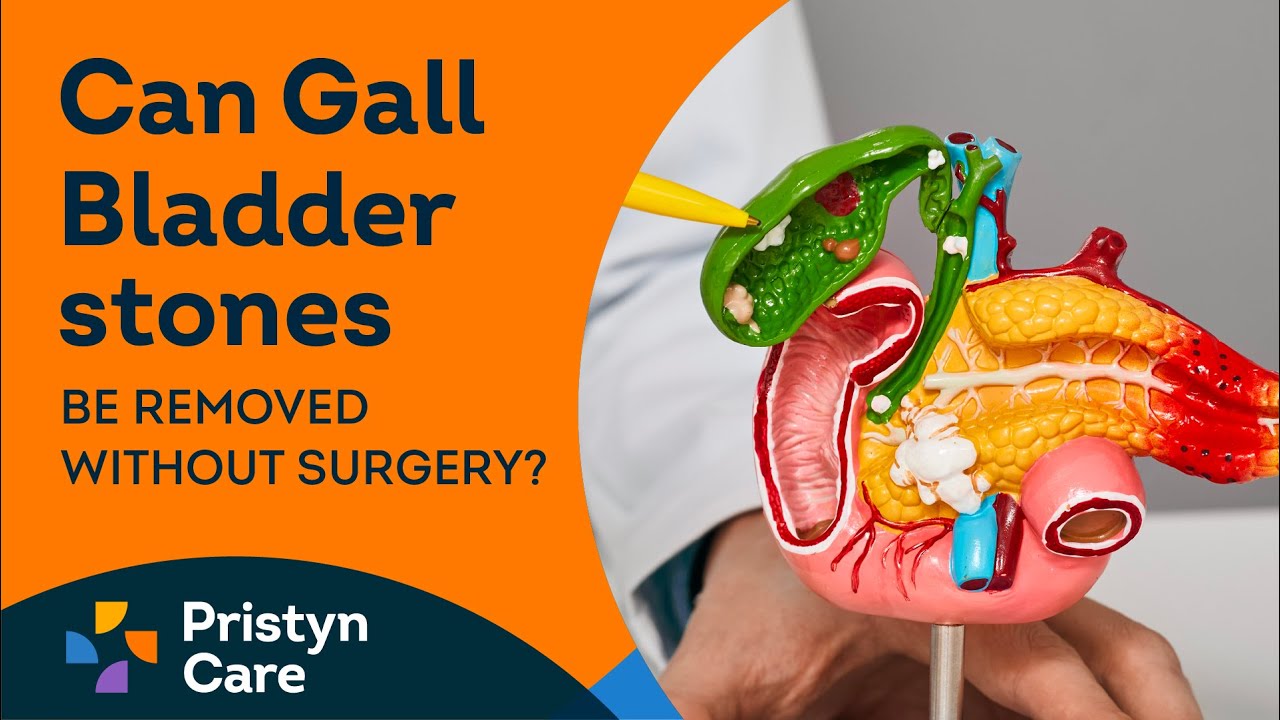 Can Gall Bladder stones be removed without surgery? For FREE Appointment Call On 08065105263