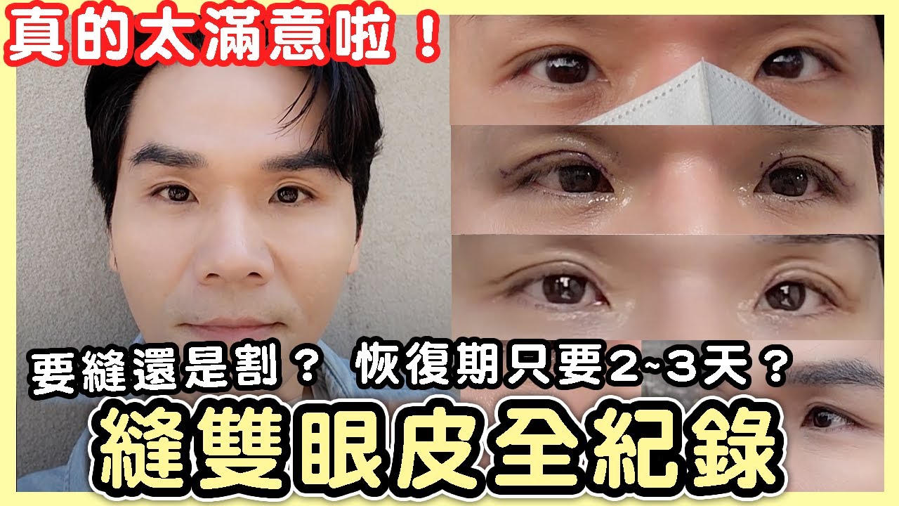 #術前術後必看 我終於去縫雙眼皮啦！真的太滿意了 ll Kevin想得美 ll