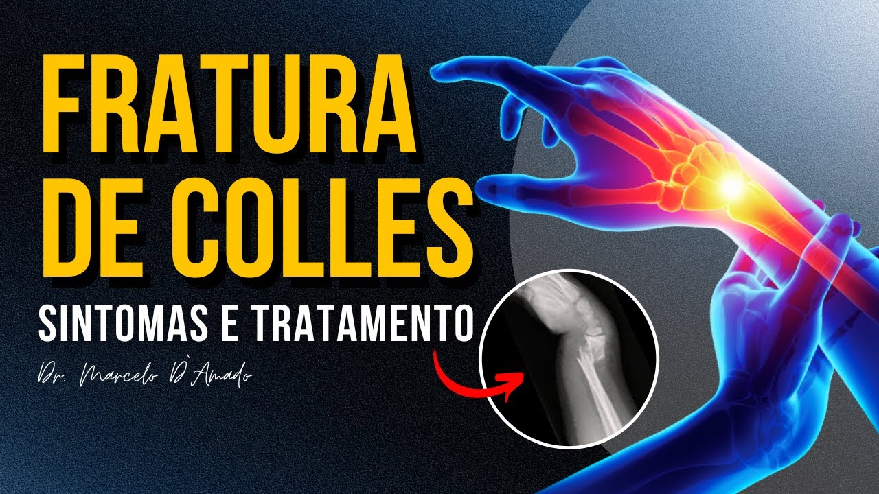 ENTENDENDO A FRATURA DE COLLES: SINTOMAS E TRATAMENTO