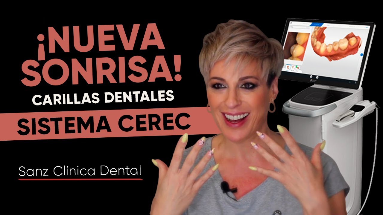SISTEMA CEREC - Cambiamos tu SONRISA😁  con CARILLAS DENTALES - SANZ CLÍNICA DENTAL