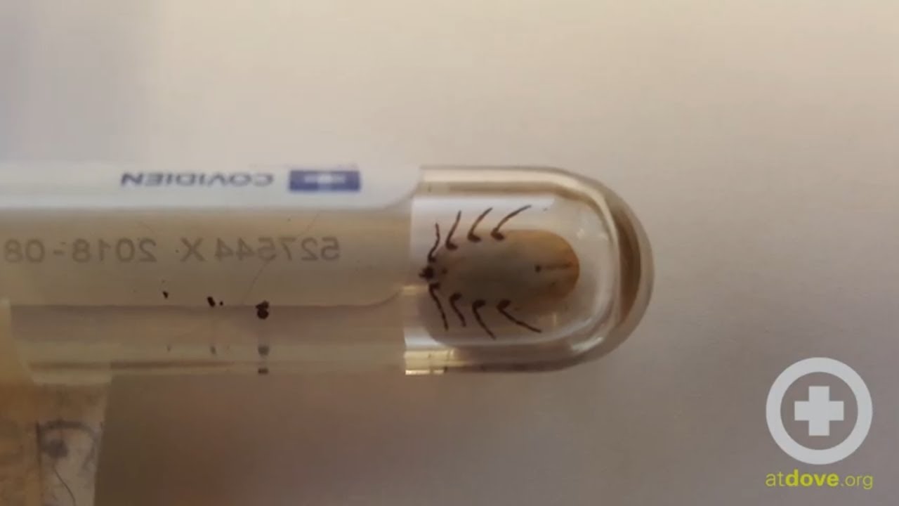 Tick Paralysis
