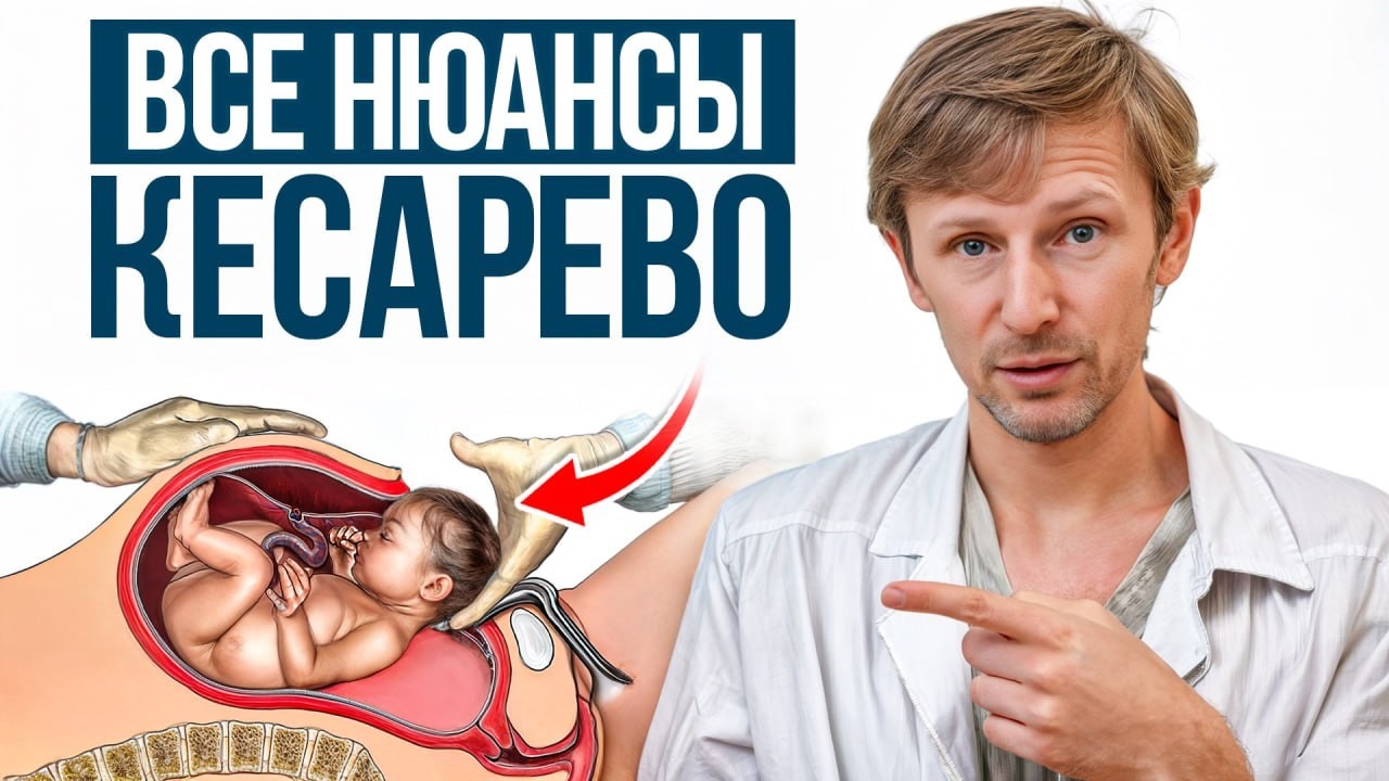 Врачи молчат об ЭТИХ последствиях КЕСАРЕВА! / Кесарево сечение или естественные роды?