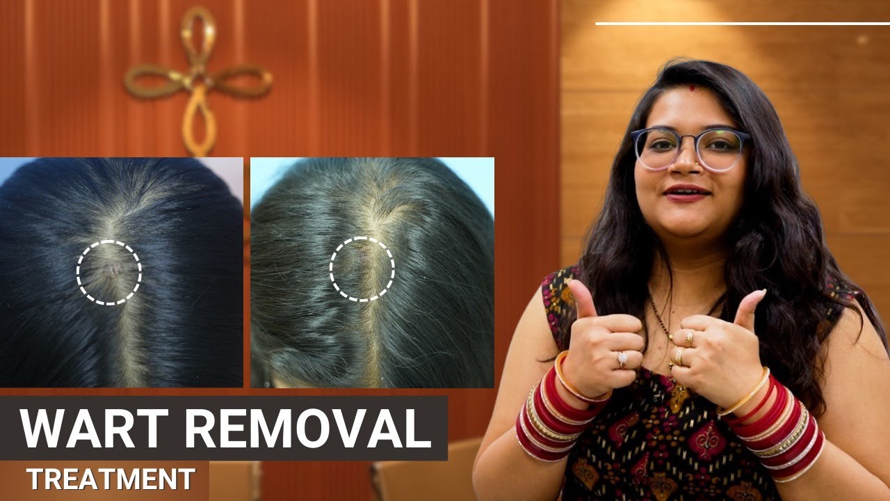 Wart removal | Wart removal laser treatment | Wart removal result by Satya Aesthetics