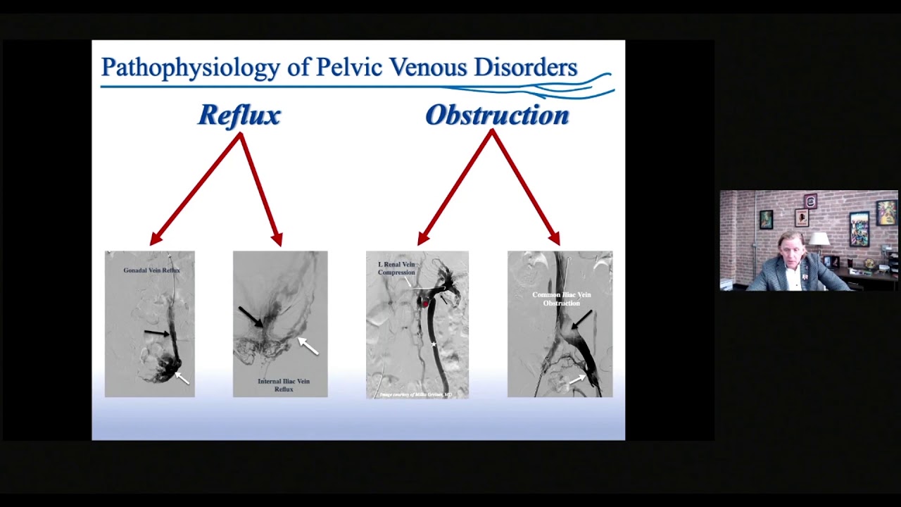 SVP Classification of Pelvic Venous Disorders