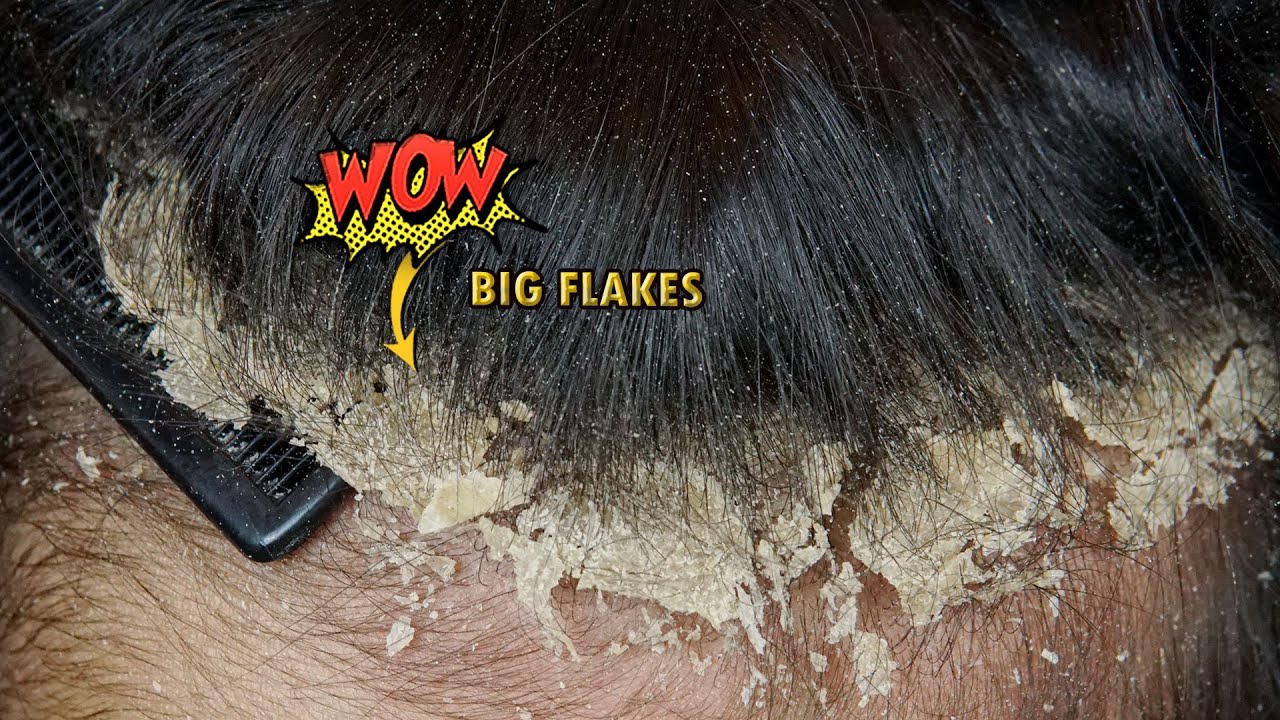 Huge Dandruff Flakes Removal #1118
