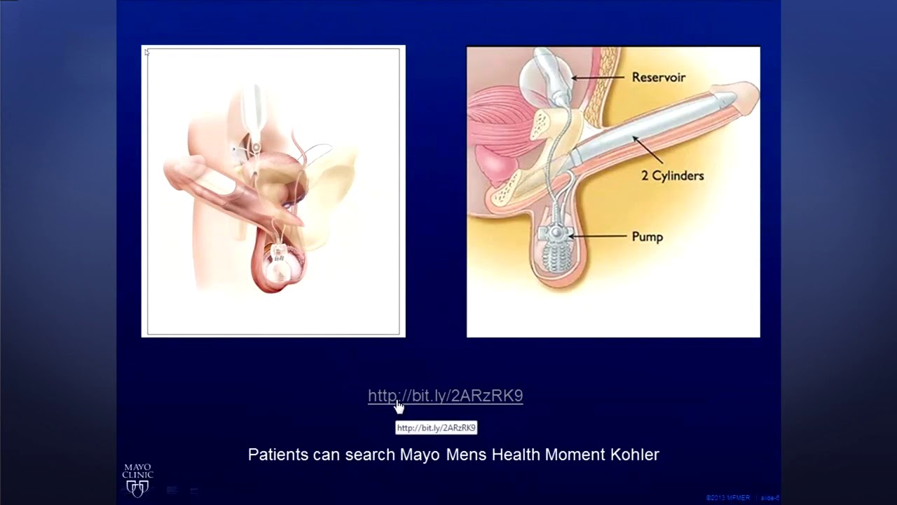 Erectile Dysfunction Solutions after Prostate Cancer Treatment