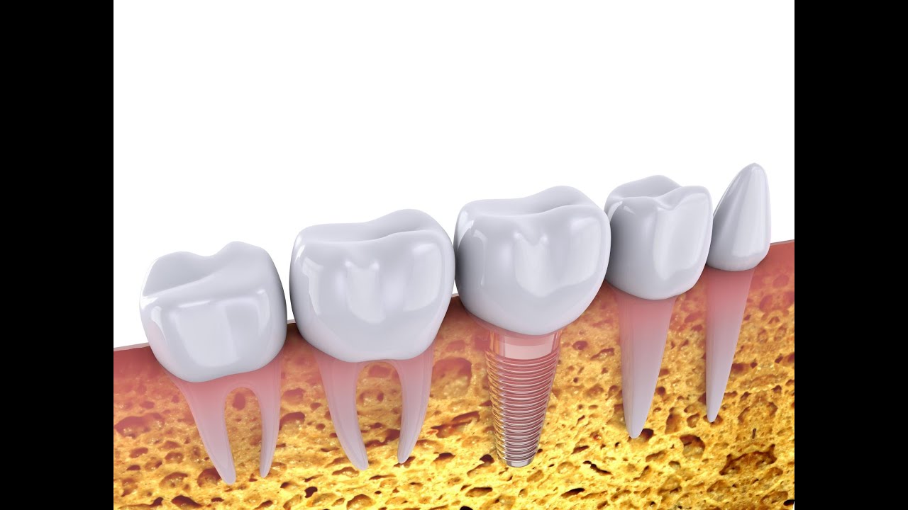 Toorak Dentist Trivia: Top 5 Myths about Dental Implants