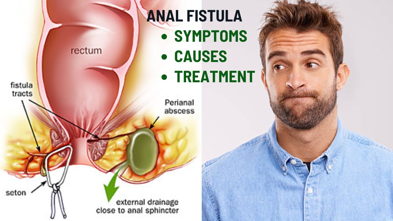 Pain, Discharge, and Swelling from Anal Fistulas? Get Expert Treatment with Dr. Shiraz Farooq