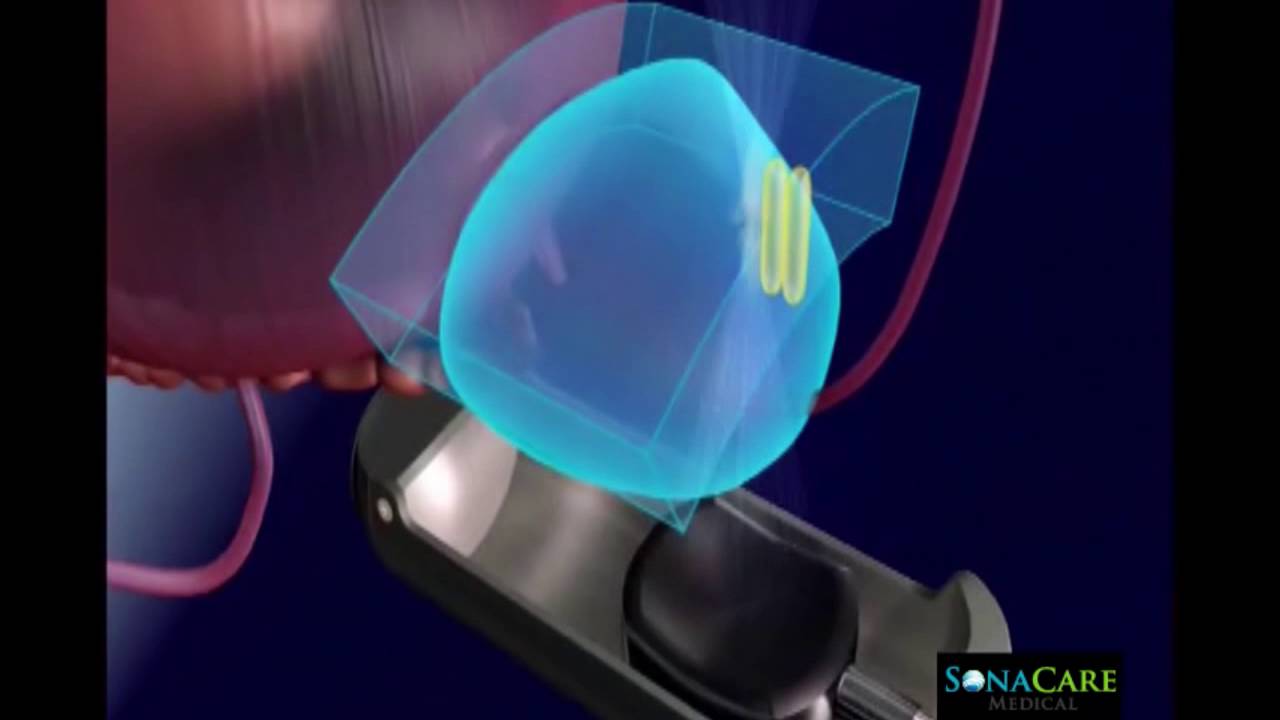 Sonablate HIFU Video: 720x1280 - wide screen