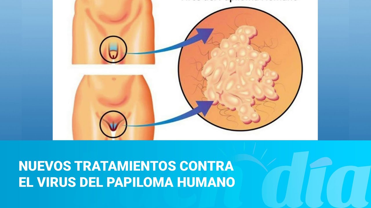 Nuevos tratamientos contra el virus del papiloma humano