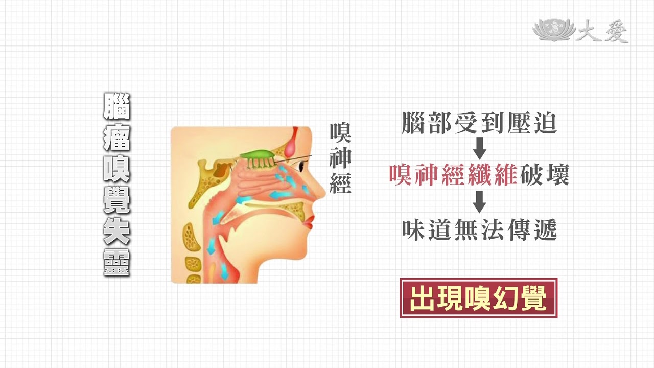 腦瘤壓迫嗅神經 患者聞到怪味道