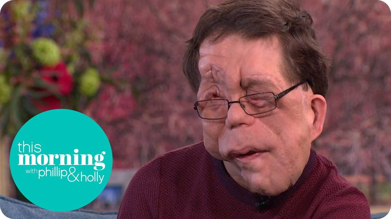 Adam Pearson Explores Freak Shows for New Documentary | This Morning