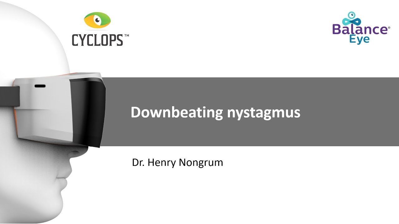 Down Beating Nystagmus - Dr. Henry Nongrum