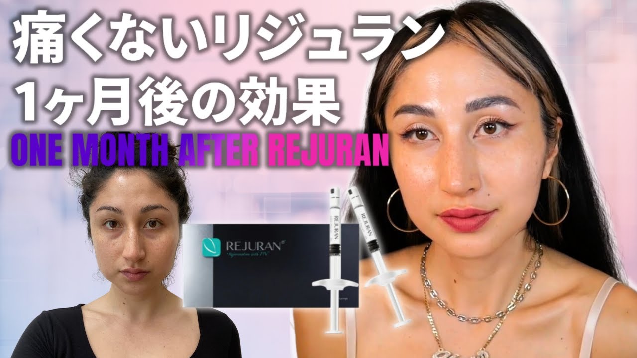 [Beauty Vlog] 東京で痛くないリジュランがある！？ Painless Rejuran in Tokyo...??