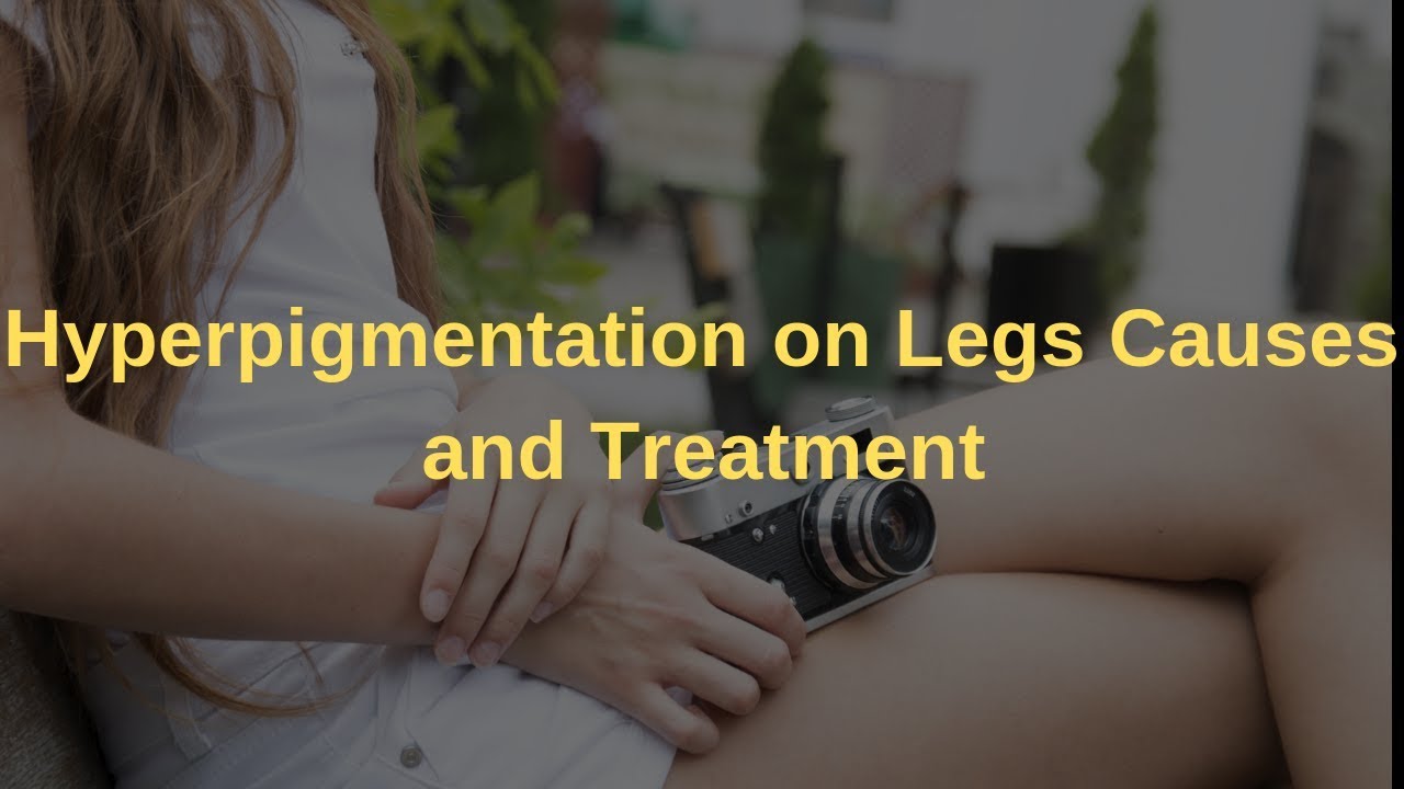 Hyperpigmentation on Legs Causes and Treatment