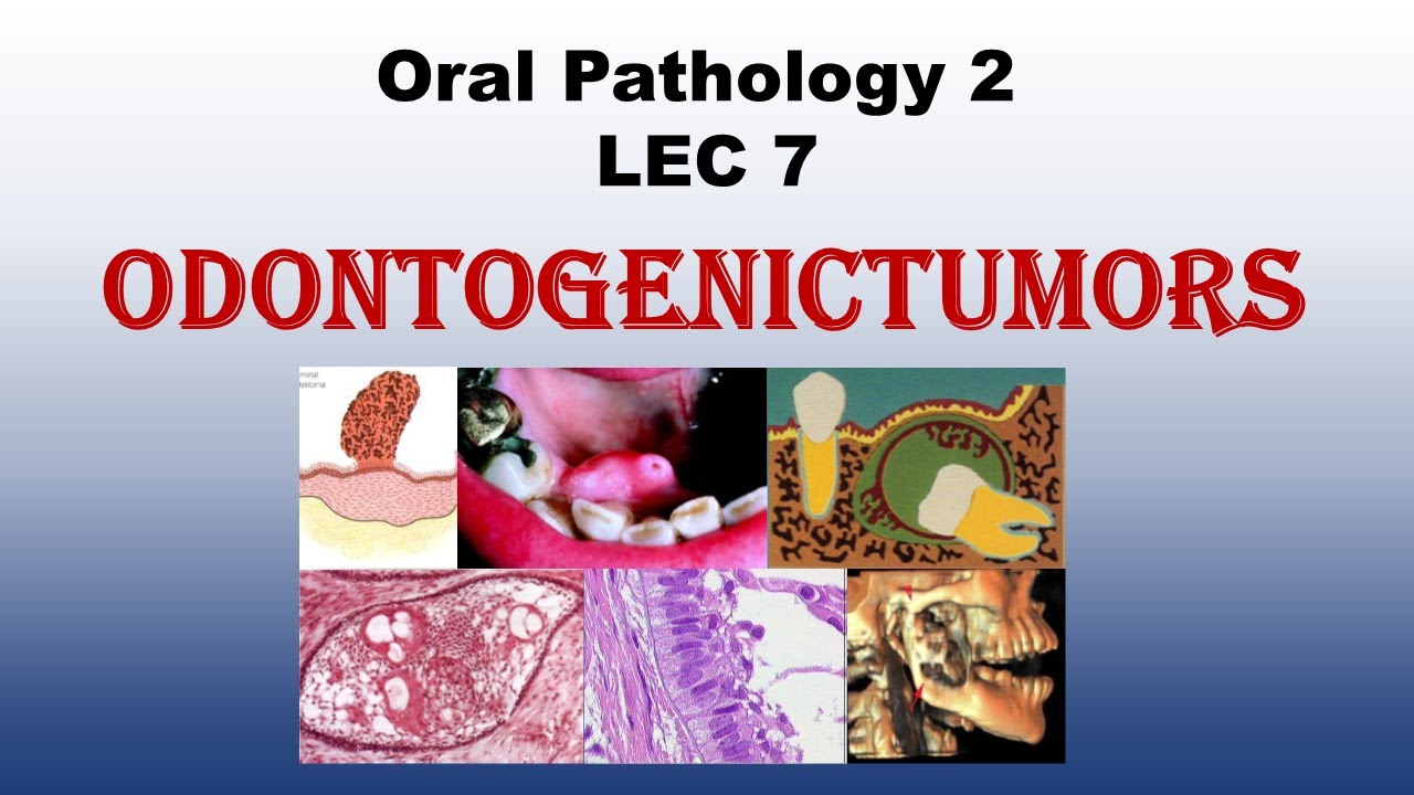 Oral Pathology 2 - LEC 7 - Odontogenic tumors Part 1