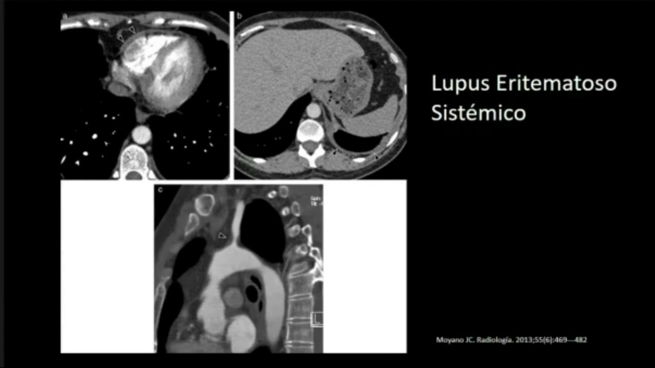 Aortitis infeccciosa - posgrado Infectología UNAL