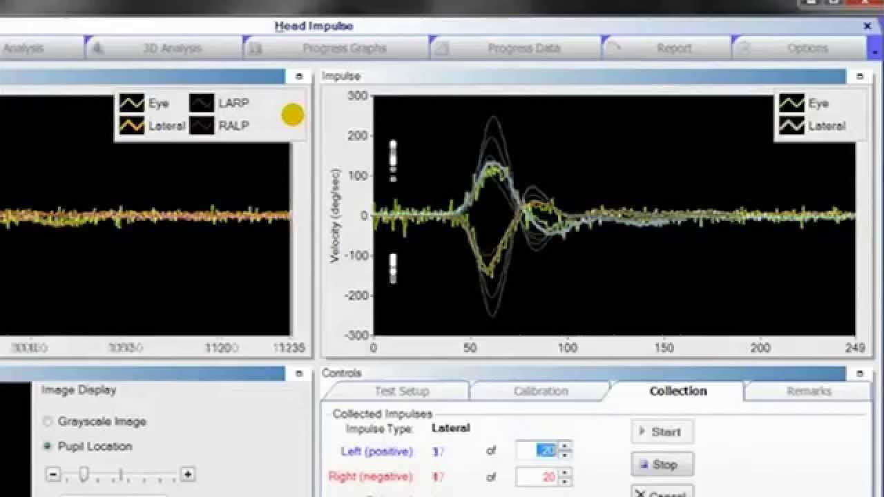ICS Impulse vHIT - Performing Lateral Head Impulses
