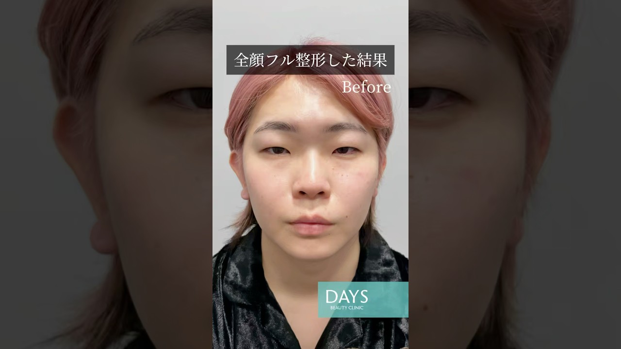 【全顔フル整形】整形感なく激変！