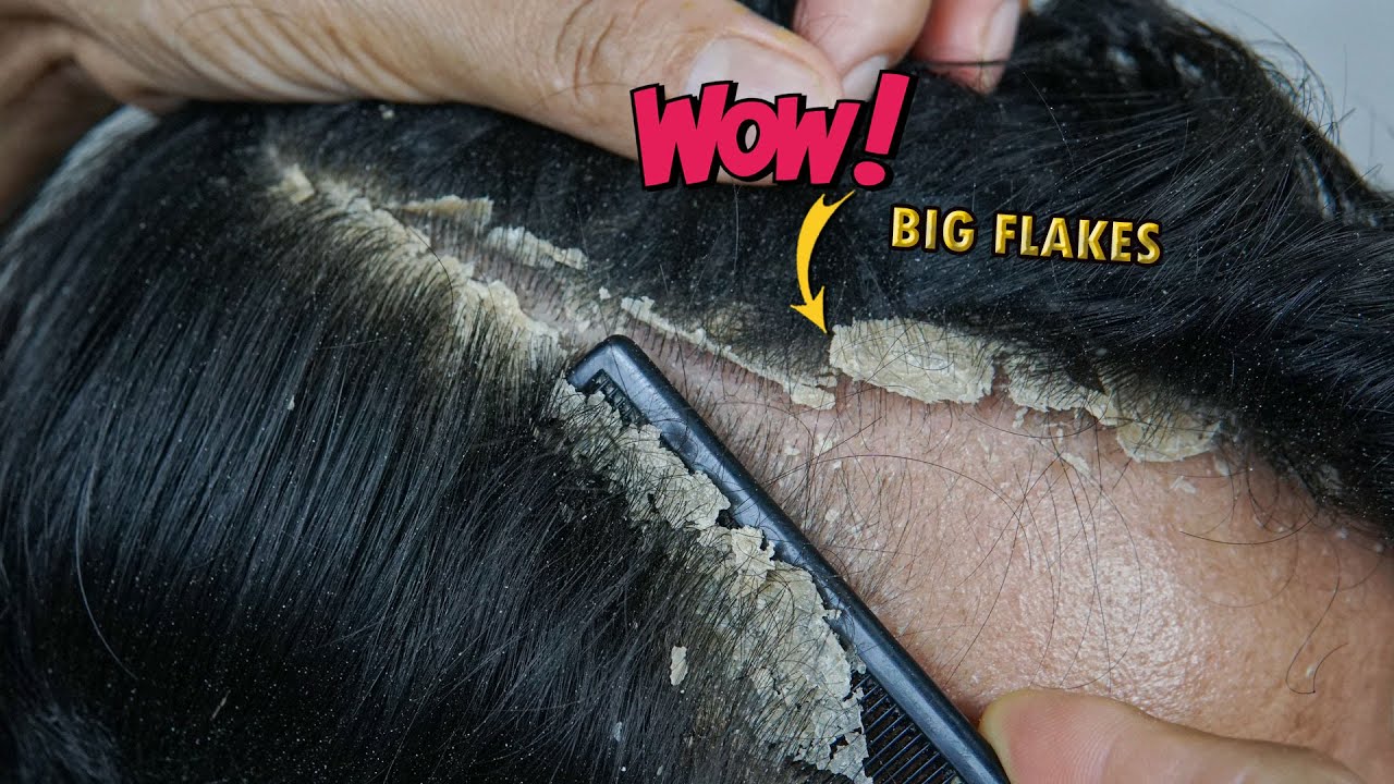 Itchy Dry Scalp Big Dandruff Scratching #1185