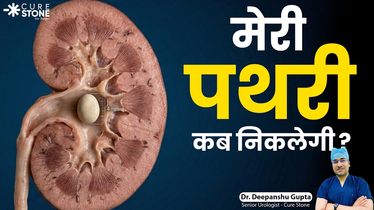 कब निकलेगा Kidney Stone? 🏥 4 Factors That Decide Stone Removal | Dr. Deepanshu Gupta