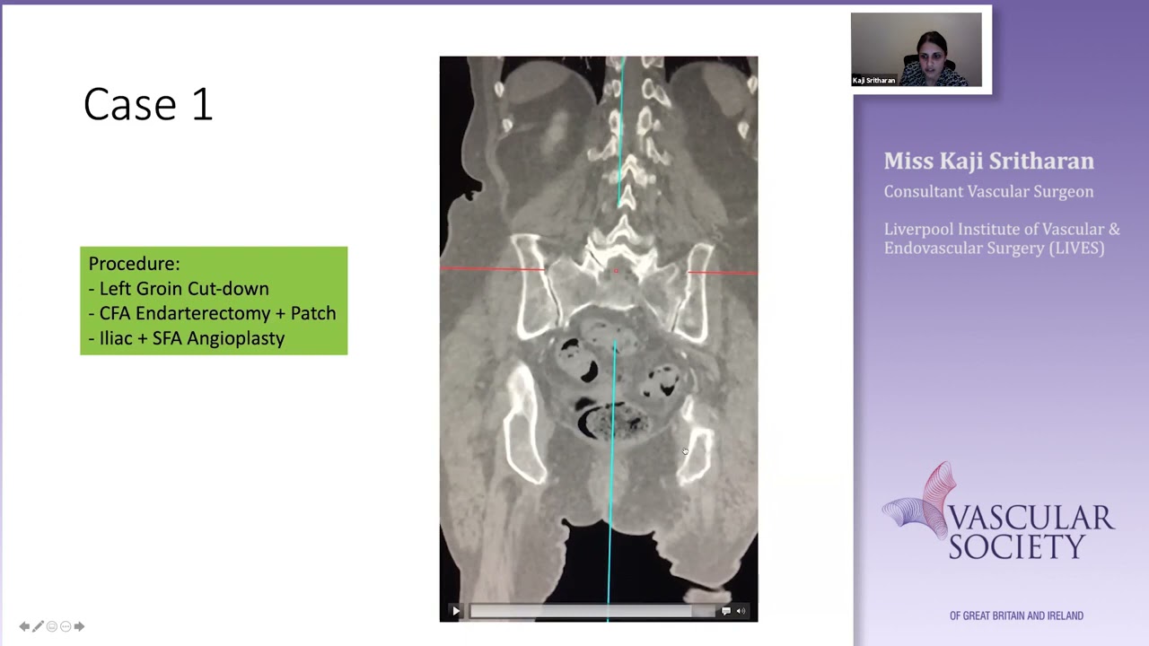 Iliac intervention: How I do it