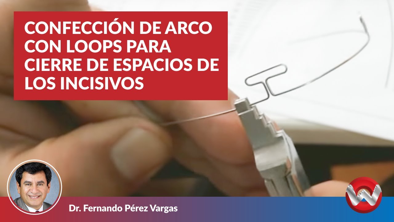 Confección de arco con loops para cierre de espacios de los incisivos