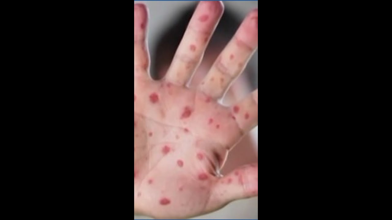 Measles cases in the US continue to rise