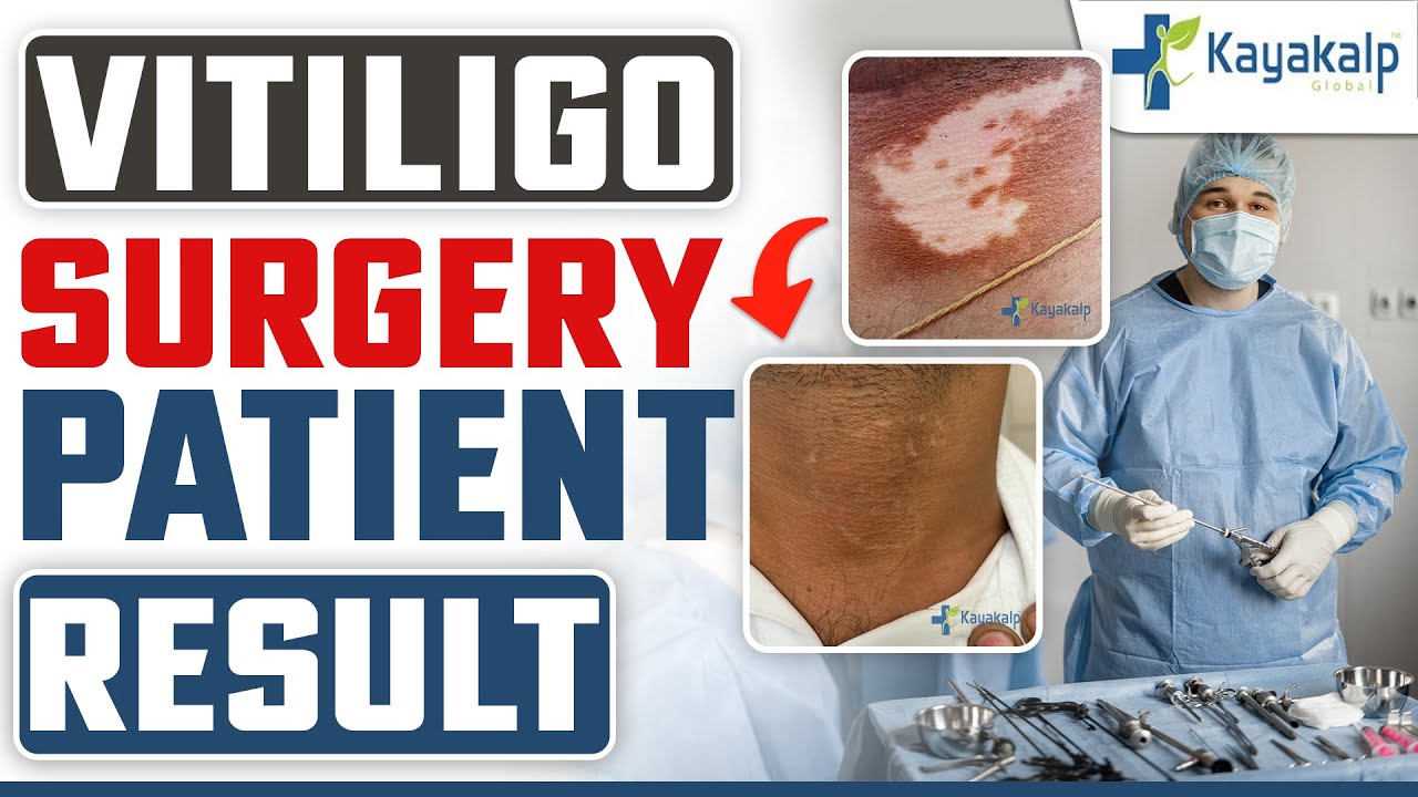 सफेद दाग (Vitiligo) की सर्जरी में कितना खर्चा आता है? Vitiligo Surgery Before and After | Kayakalp
