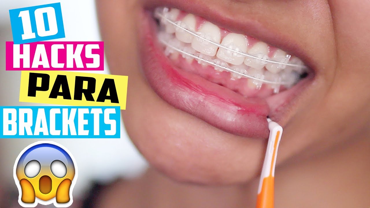 10 HACKS / TRUCOS PARA QUIENES TIENEN BRACKETS 😱