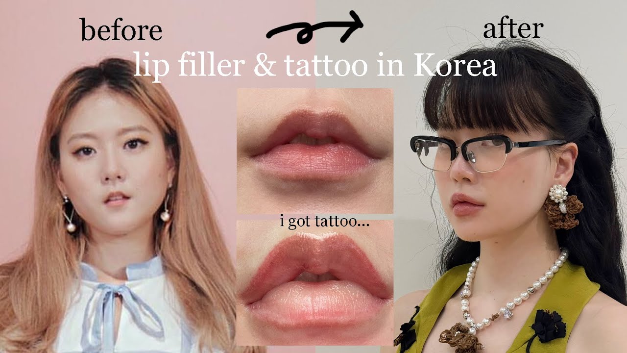 My lip filler & tattoo journey in Korea (cost, pros & cons, things to look out for)