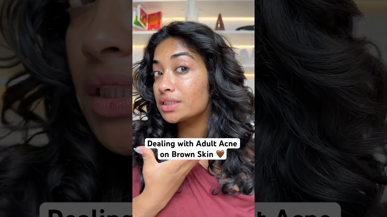 HAVING ADULT ACNE IS NOT FOR THE WEAK⁉️