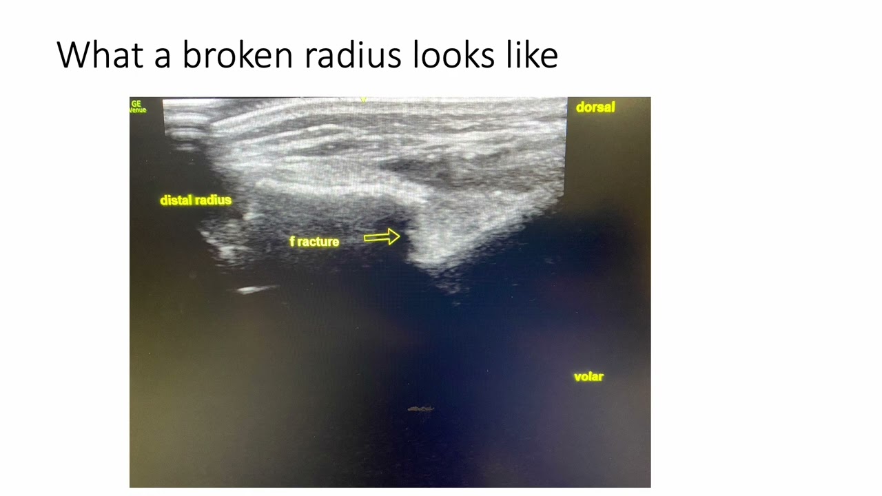 Distal Radius Fractures
