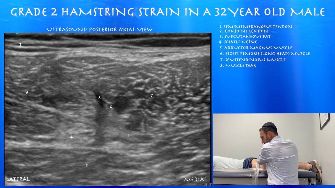 Grade 2 Hamstring Strain by probeultrasound.com