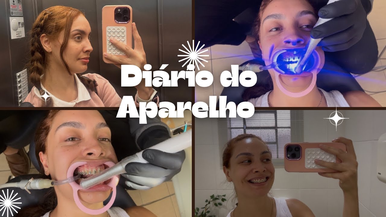 Colocando a parte de baixo do meu aparelho auto ligado 😬 #aparelhoortodôntico #dentista #odontologia