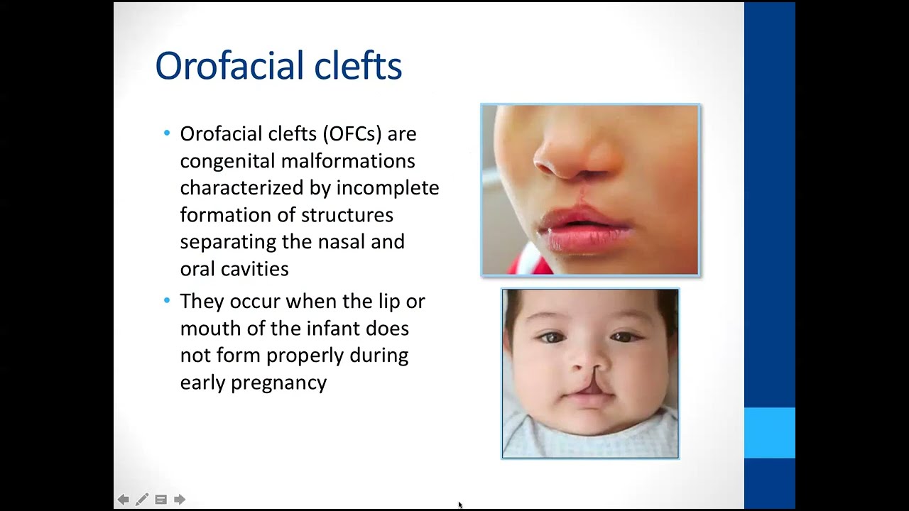 CED Ability Grand Rounds Webinar: Services & Supports for Parents of Children w/ Orofacial Clefts