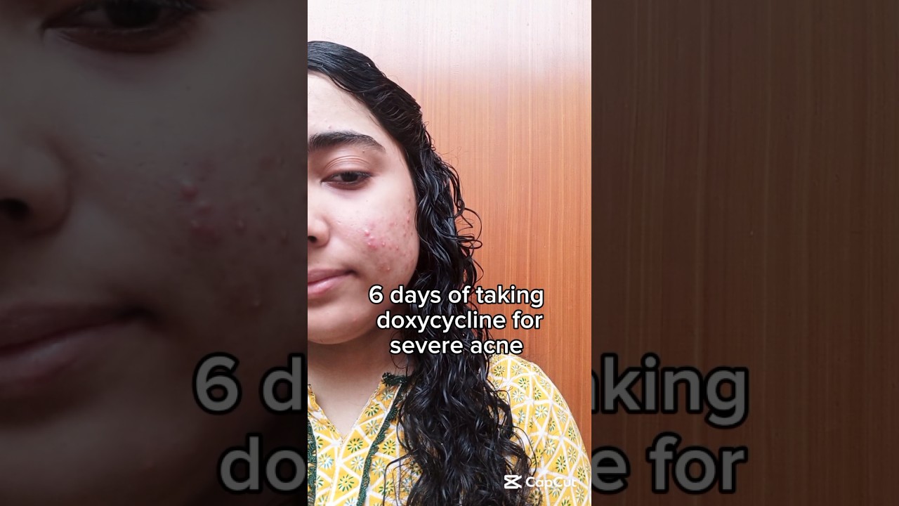 6 days of taking doxycycline for severe acne 🍈 acne treatment 🍂 oral antibiotics for acne