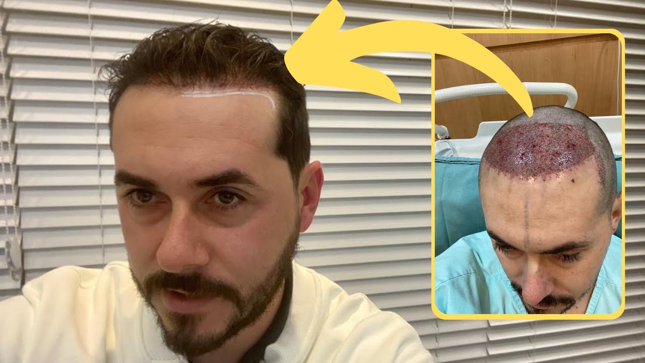 EVOLUÇÃO TRANSPLANTE CAPILAR 11 MESES - ESTOU PENSANDO EM FAZER OUTRO TRANSPLANTE CAPILAR