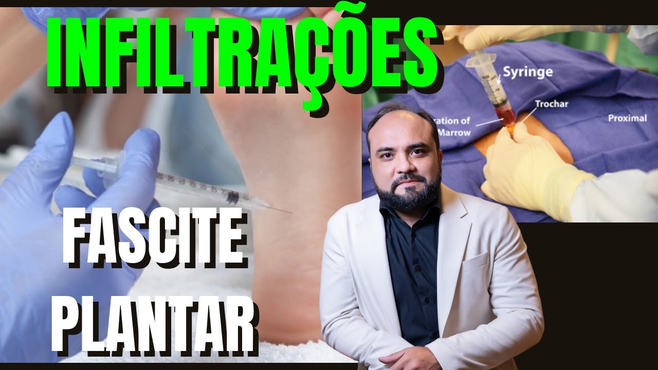 Tipos de INFILTRAÇÕES para FASCITE PLANTAR