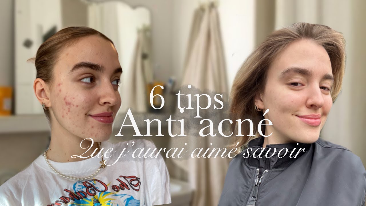 6 tips anti-acné que j'aurai aimé savoir !