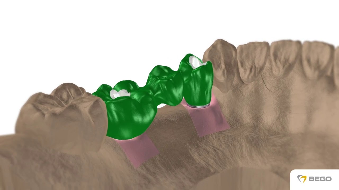 BEGO Semados Universal Abutment no Hex