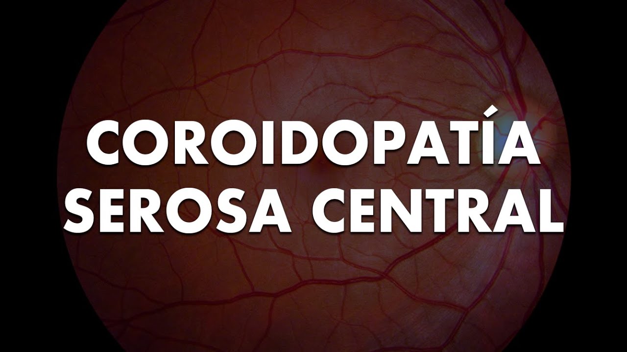 Coroidopatía serosa central Dra. Ángela María Fajardo 28 Junio 2024